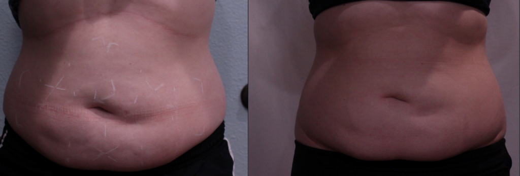 TruSculpt ID Before and After Photo by Dr. Murphy in San Antonio Texas