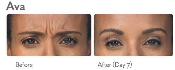 Botox Before and After Photo by Dr. Murphy in San Antonio Texas Botox Before and After Photo by Dr. Murphy in San Antonio Texas