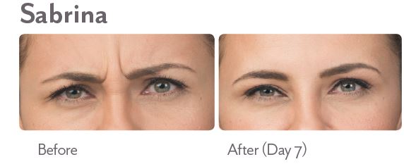 Botox Before and After Photo by Dr. Murphy in San Antonio Texas