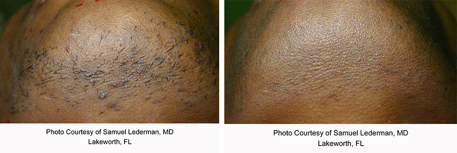 Laser Hair Removal Before and After Photo by Dr. Murphy in San Antonio Texas