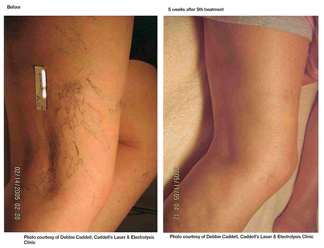 Laser Vein Treatment Before and After Photo by Dr. Murphy in San Antonio Texas