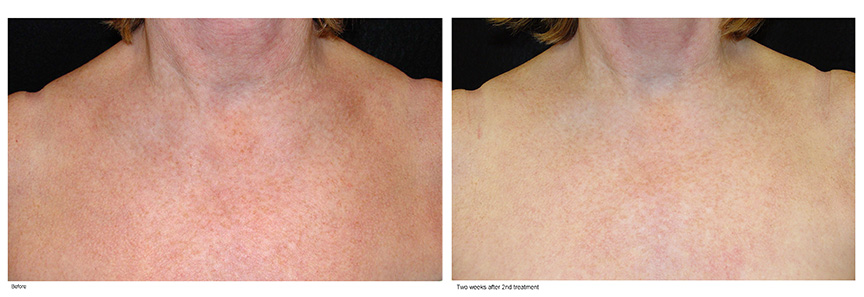 Limelight Before and After Photo by Dr. Murphy in San Antonio Texas