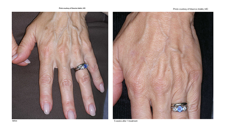 Limelight Before and After Photo by Dr. Murphy in San Antonio Texas