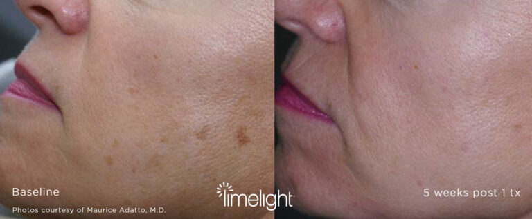 Limelight Before and After Photo by Dr. Murphy in San Antonio Texas Limelight Before and After Photo by Dr. Murphy in San Antonio Texas