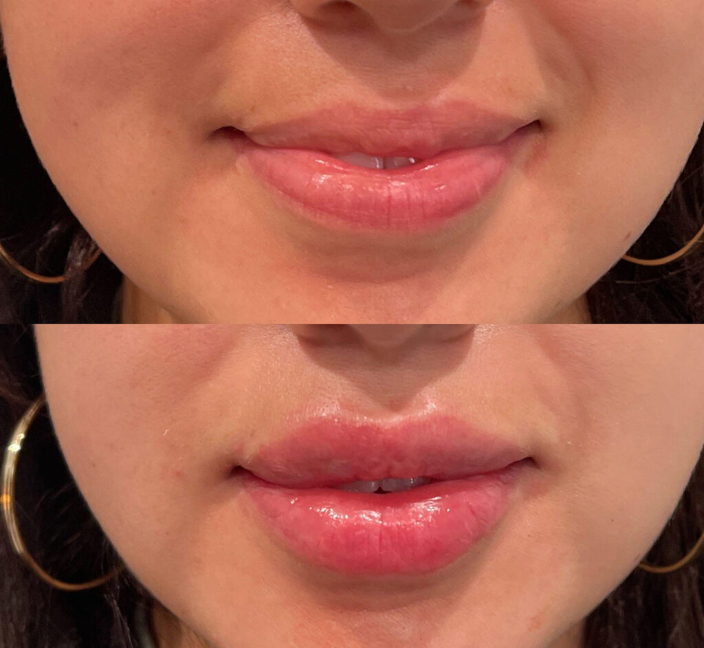 Lip Filler Before and After Photo by Dr. Murphy in San Antonio Texas