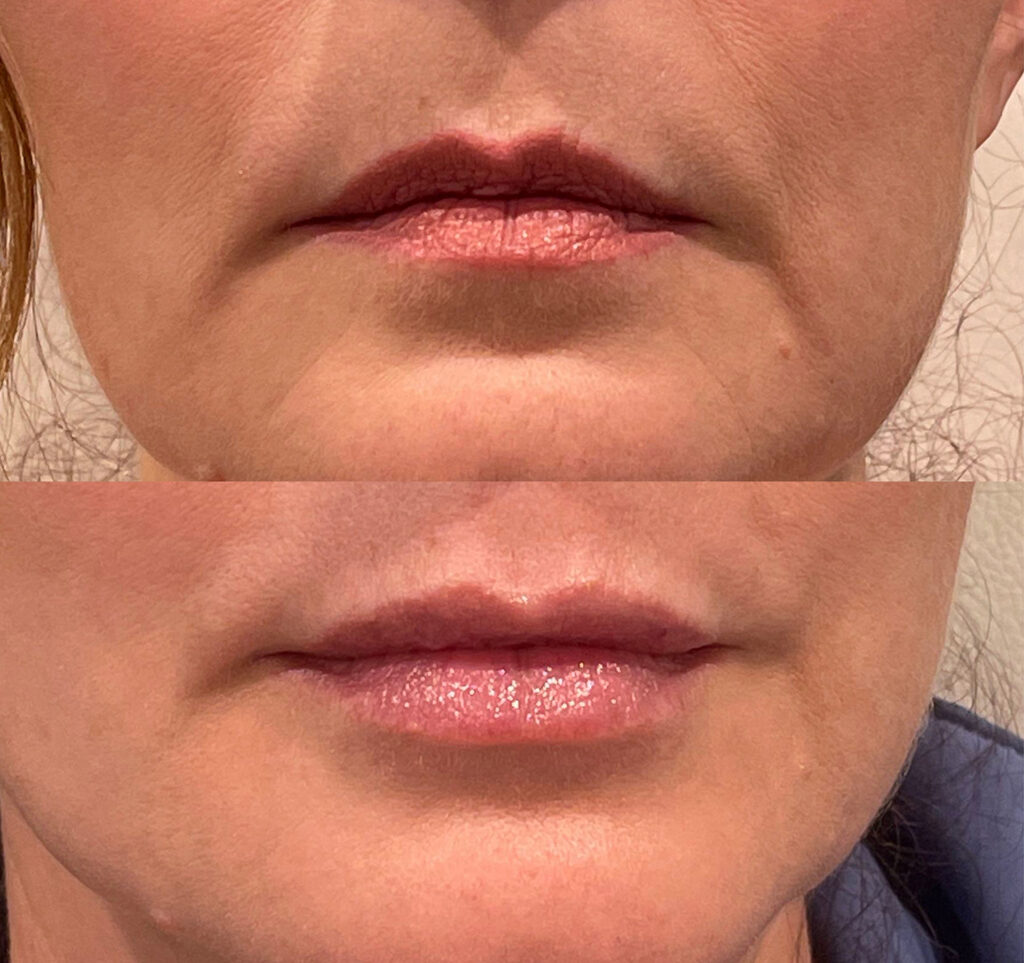 Lip Filler Before and After Photo by Dr. Murphy in San Antonio Texas