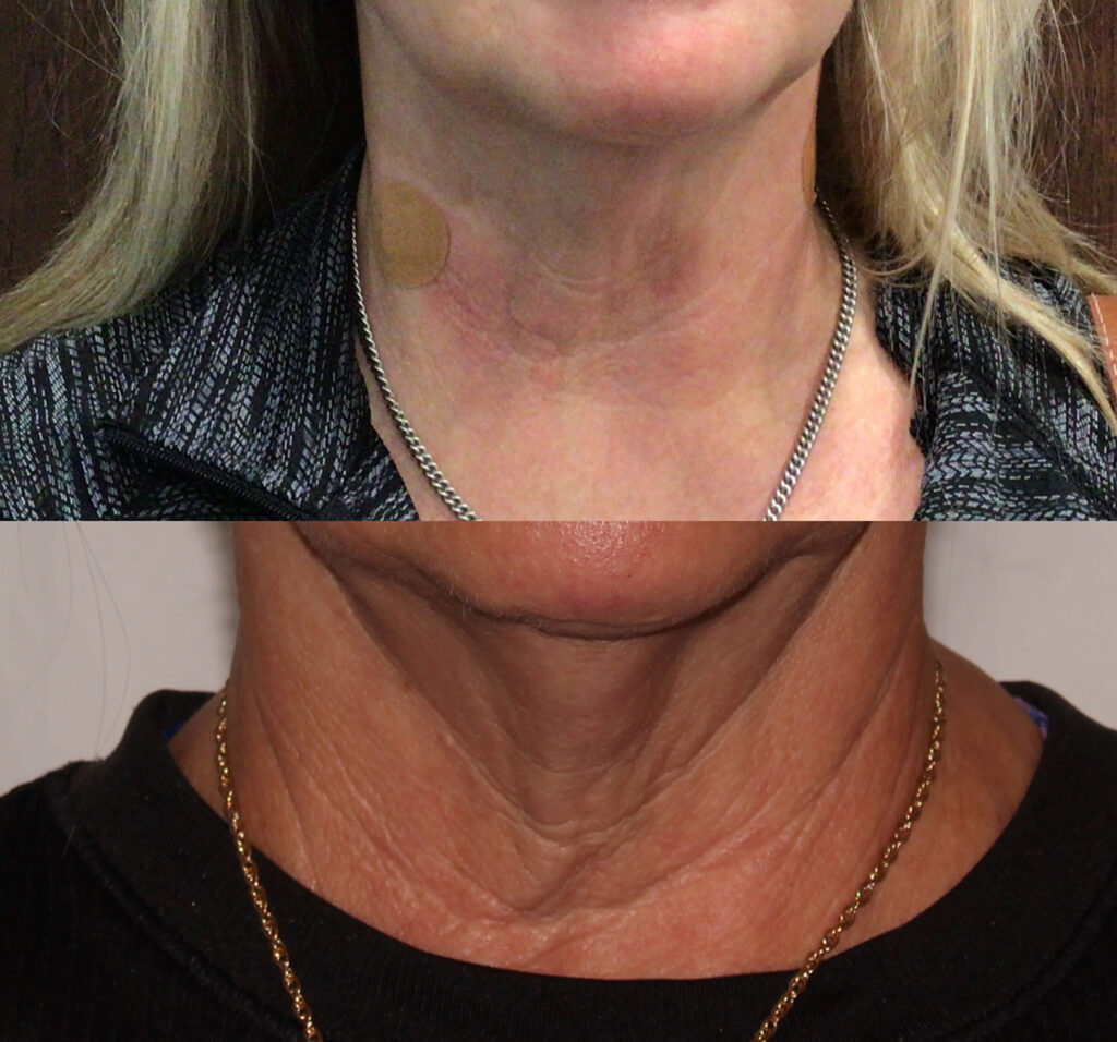 Neck Renewal Pkg Before and After Photo by Dr. Murphy in San Antonio Texas