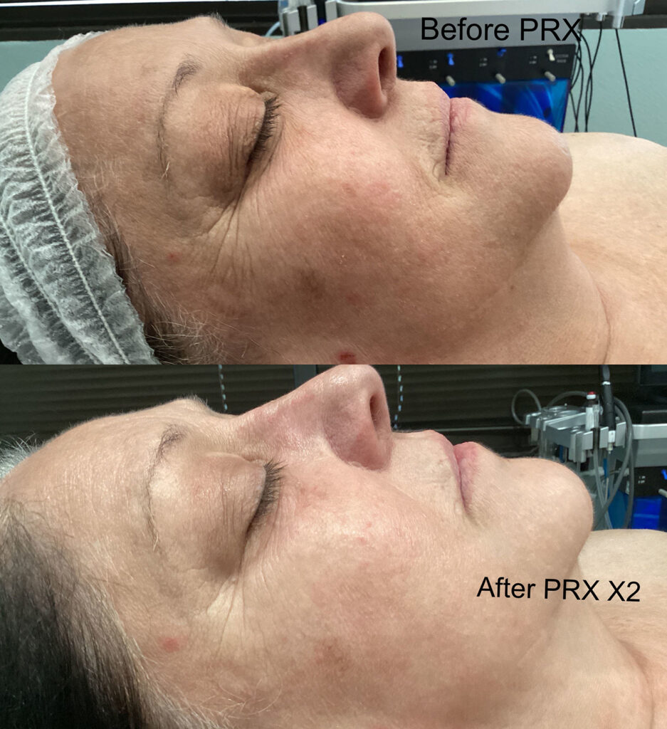 PRX Before and After Photo by Dr. Murphy in San Antonio Texas