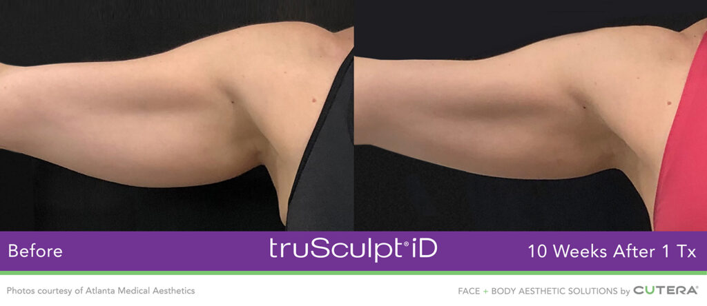 TruSculpt ID Before and After Photo by Dr. Murphy in San Antonio Texas