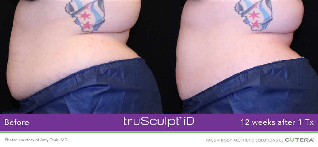 TruSculpt ID Before and After Photo by Dr. Murphy in San Antonio Texas