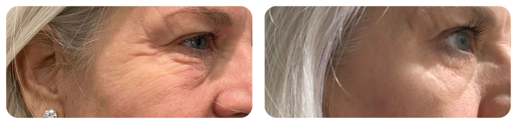 Botox Before and After Photo by Dr. Bill Murphy MD and the Turquoise Springs Medical Spa team in San Antonio Texas