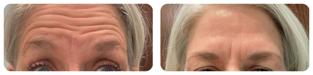 Botox Before and After Photo by Dr. Bill Murphy MD and the Turquoise Springs Medical Spa team in San Antonio Texas