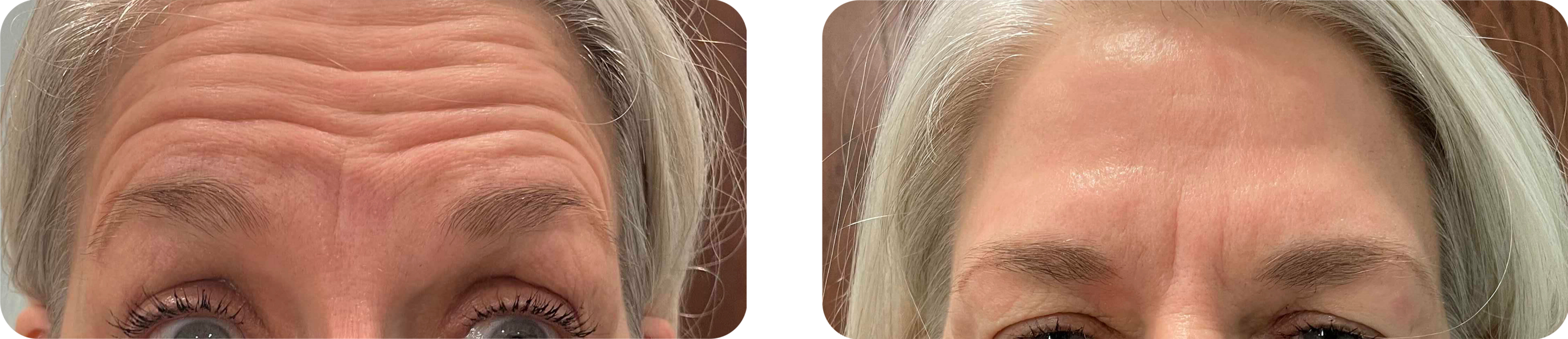 Botox Before and After Photo by Dr. Bill Murphy MD and the Turquoise Springs Medical Spa team in San Antonio Texas Botox Before and After Photo by Dr. Bill Murphy MD and the Turquoise Springs Medical Spa team in San Antonio Texas