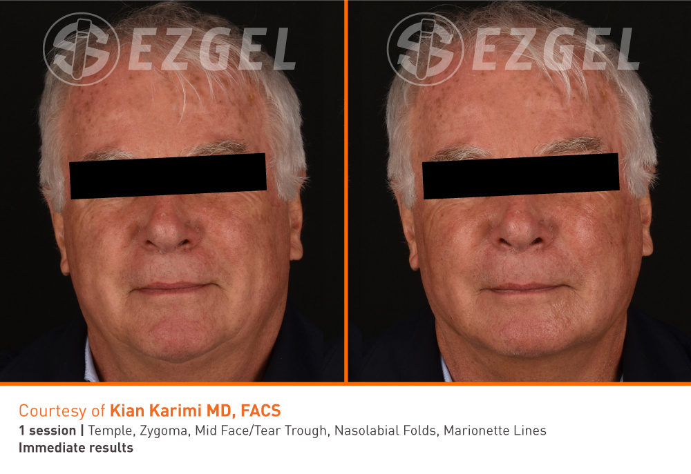 ezgel before after