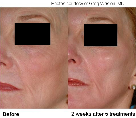 laser genesis before after