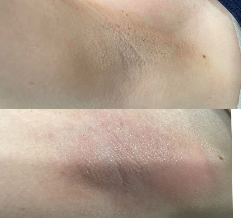 laser hair removal before after