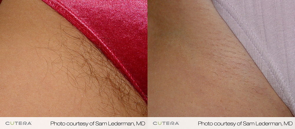 laser hair removal before after