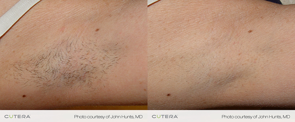 laser hair removal before after