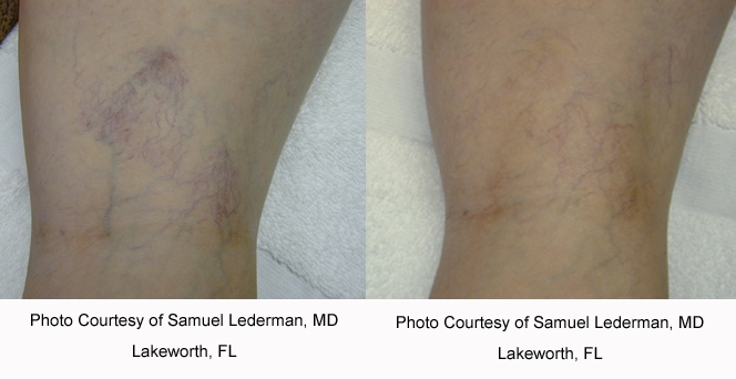 laser vein treatment before after