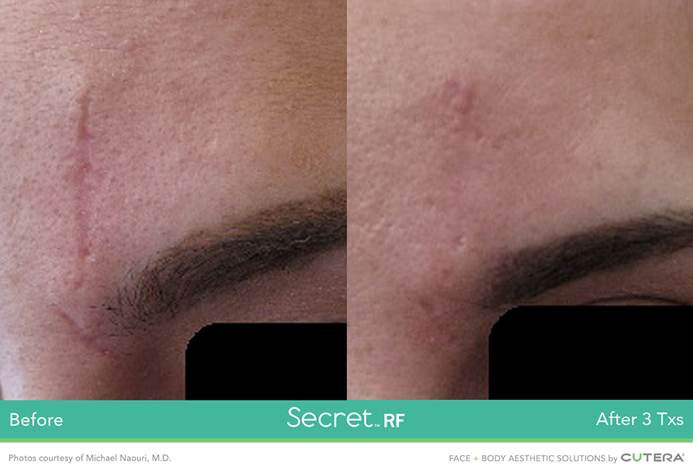 secret rf before after