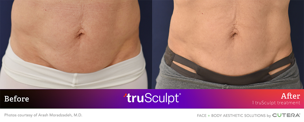 trusculpt id before after