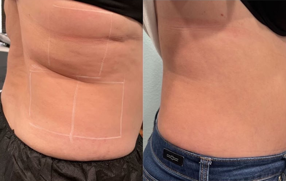 trusculpt id before after