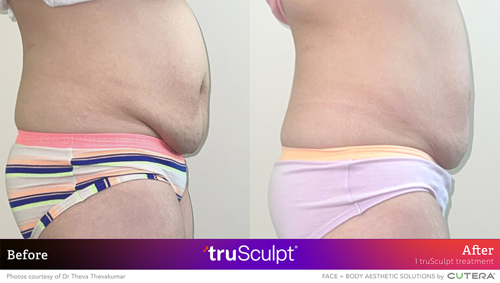 trusculpt id before after