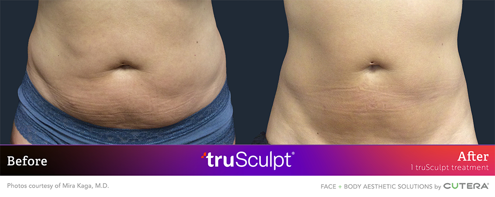 trusculpt id before after